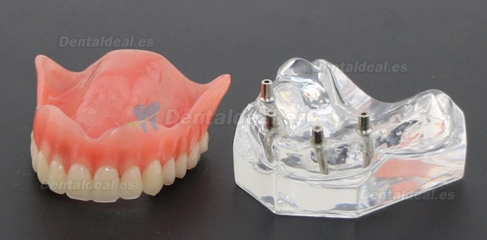 Dental Study Teeth Model Overdenture Superior With 4 Implants Demo Model 6001